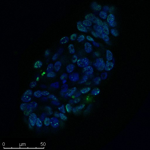Organoid of a HNC patient, treated with the drug cisplatin. Cell nuclei are visible in blue and DNA damage in green. Credit: Organoid group, copyright Hubrecht Institute.